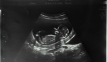 abortion